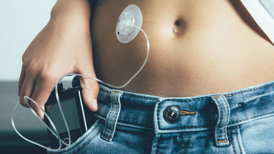Insulin Pump